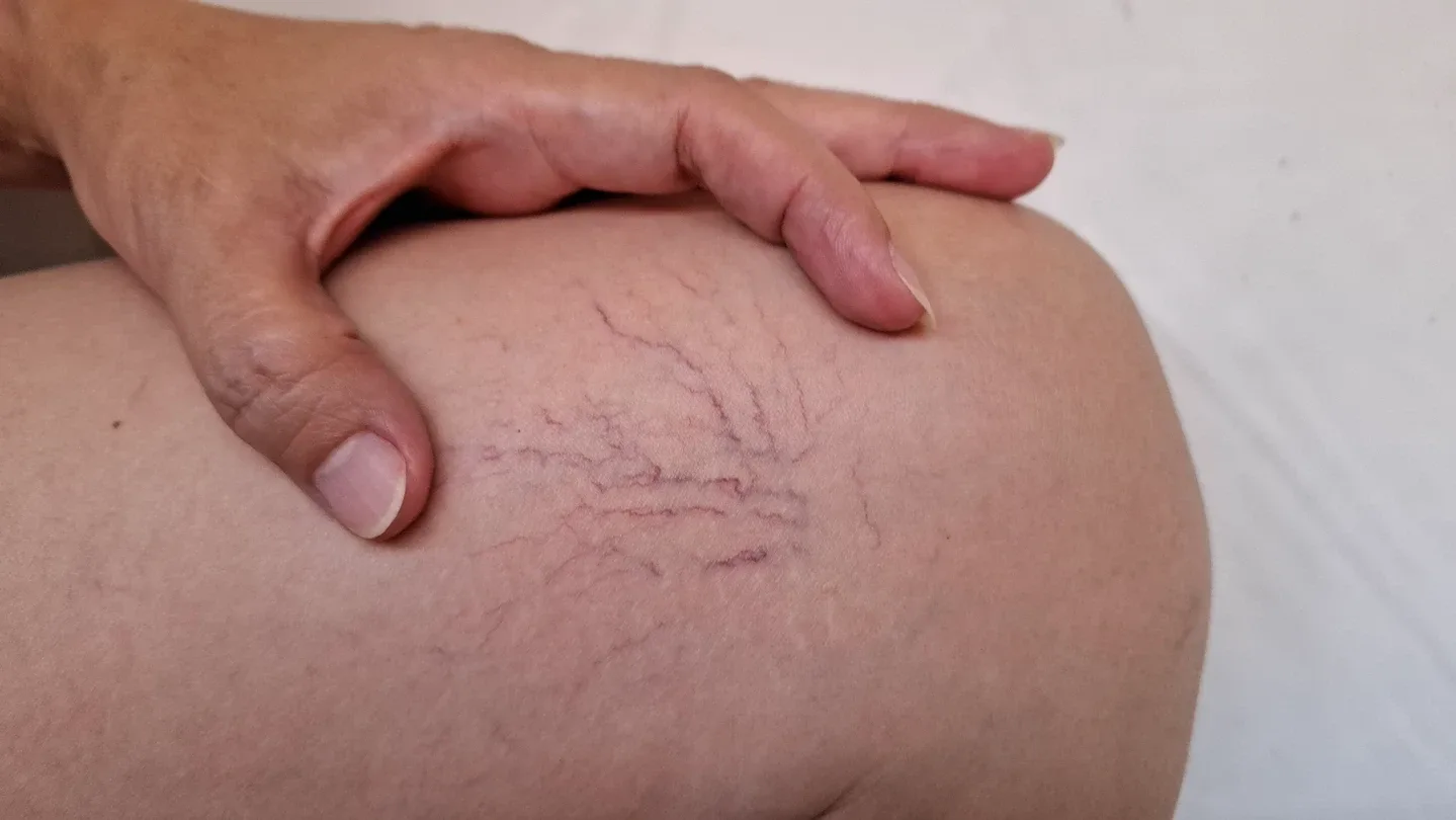 Can Spider Veins Disappear and Come Back?