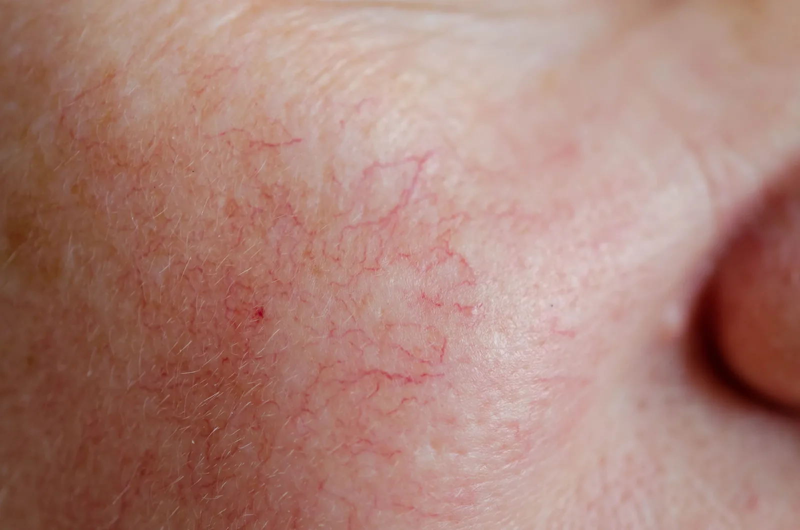 What Causes Facial Thread Veins?