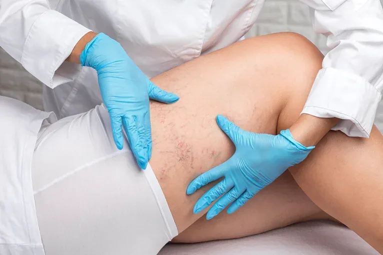 A doctor checking a leg with chronic venous insufficiency