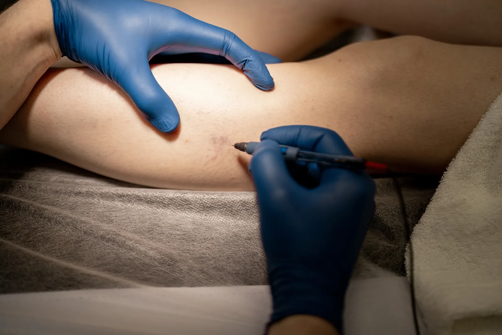 Get Relief from Chronic Venous Insufficiency with Proper