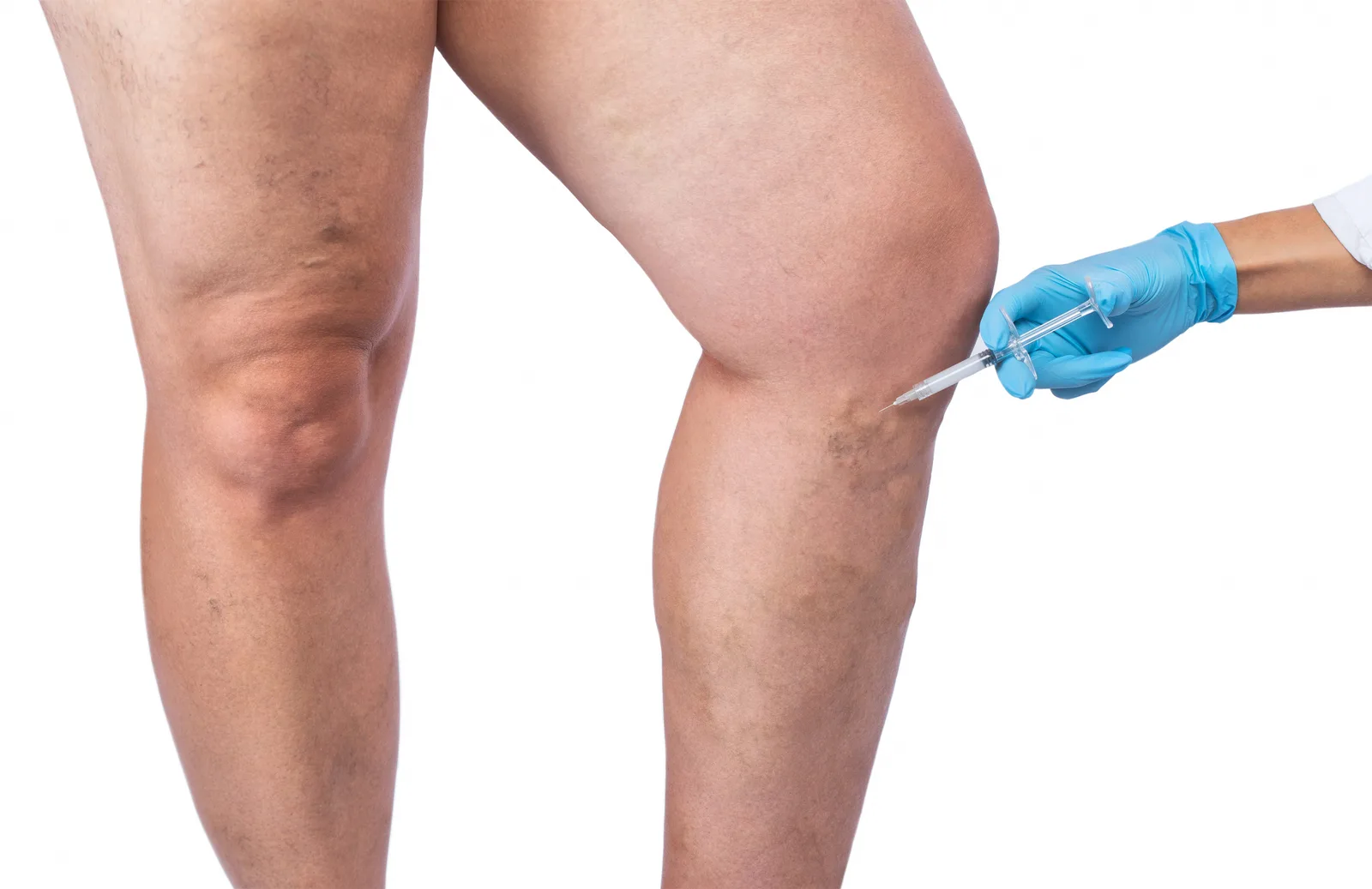 Cost of Chronic Venous Insufficiency Treatments