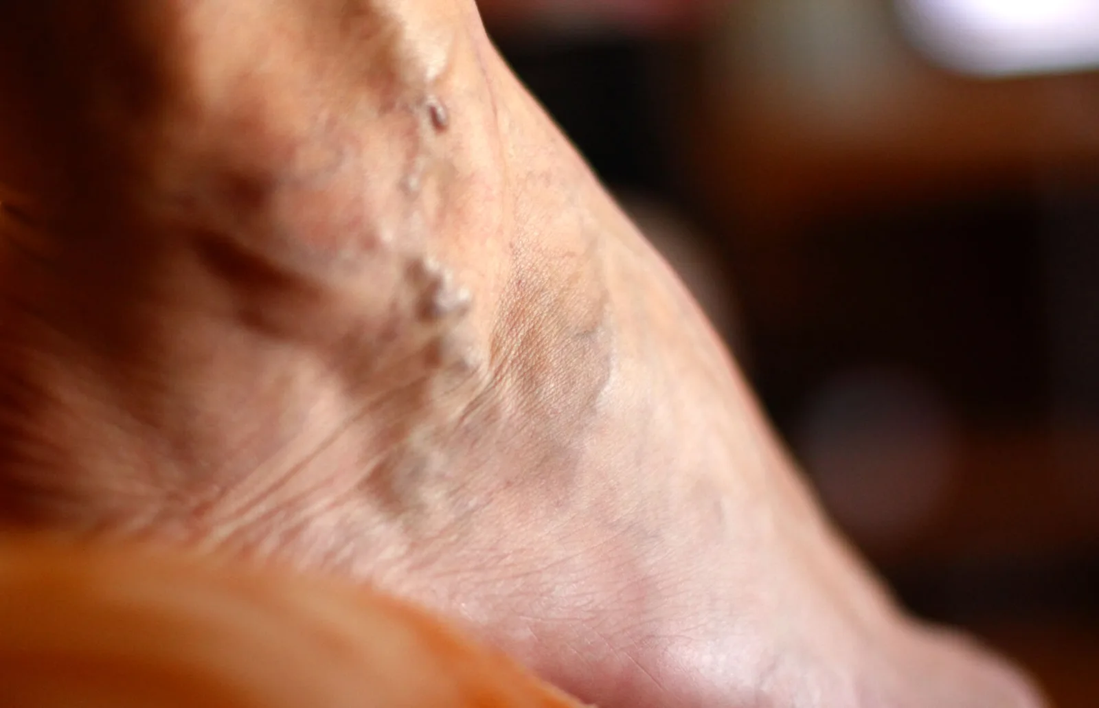 What Is the Hard Lump on the Varicose Vein?