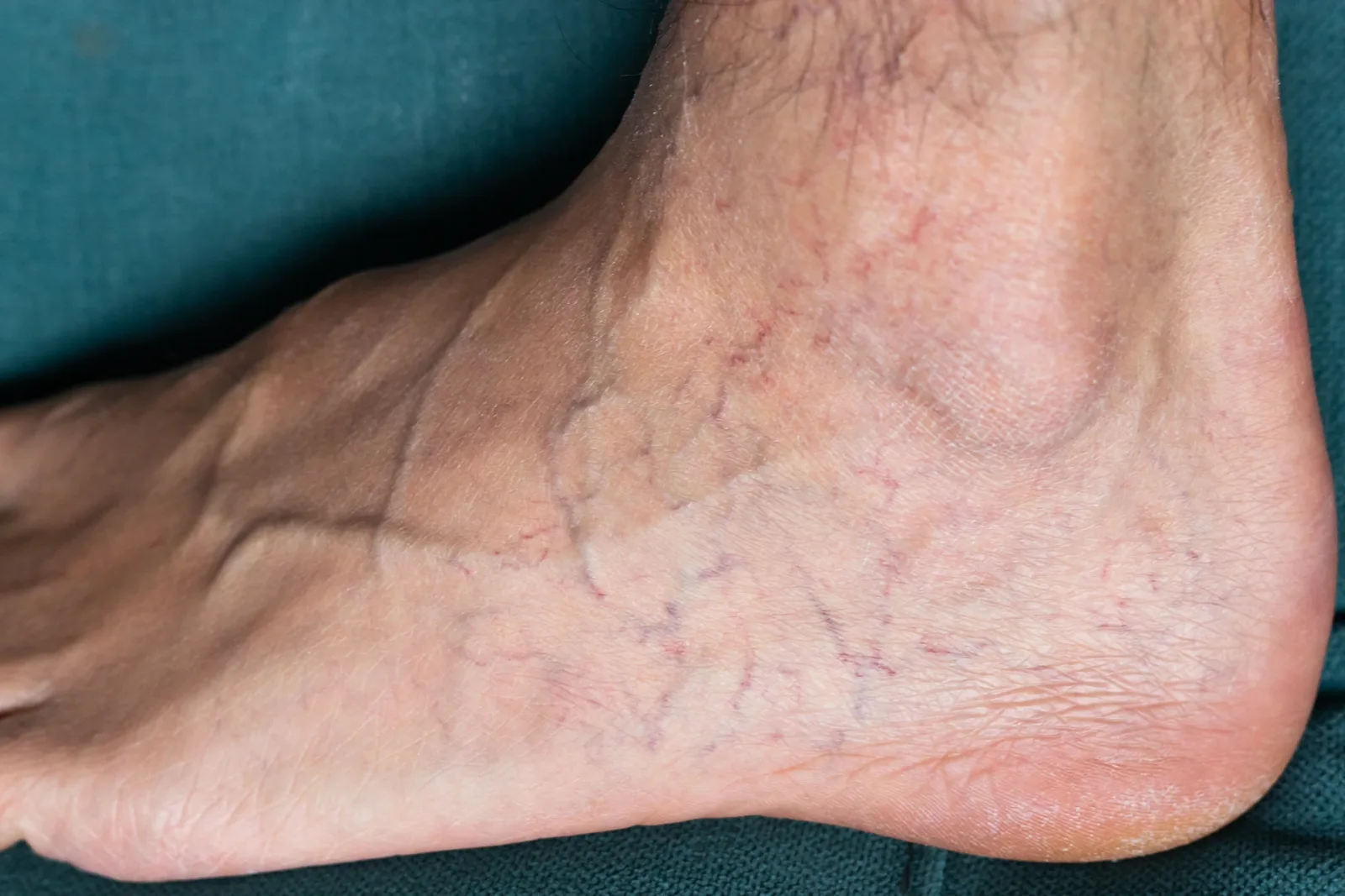 How To Recognize and Treat Irritating Inner Ankle Spider