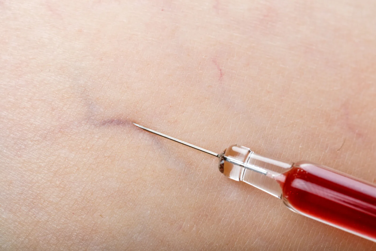 Spider Veins Treatment Costs: How To Make Spider Vein