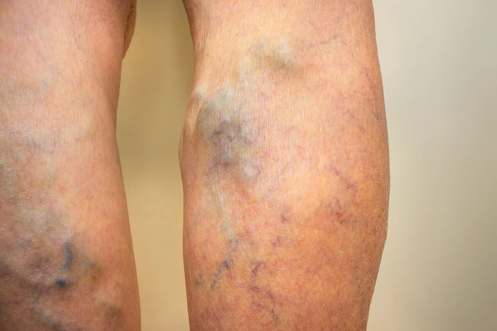 How Klippel-Trénaunay Syndrome Affects Veins and Limb
