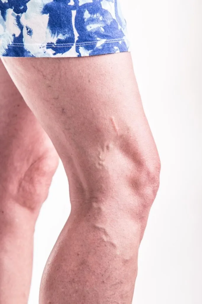 Are Your Varicose Veins Causing Leg Cramps? Don't Ignore