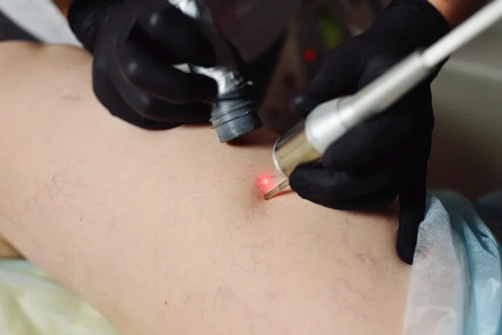 How Varicose Vein Treatment With Laser Works