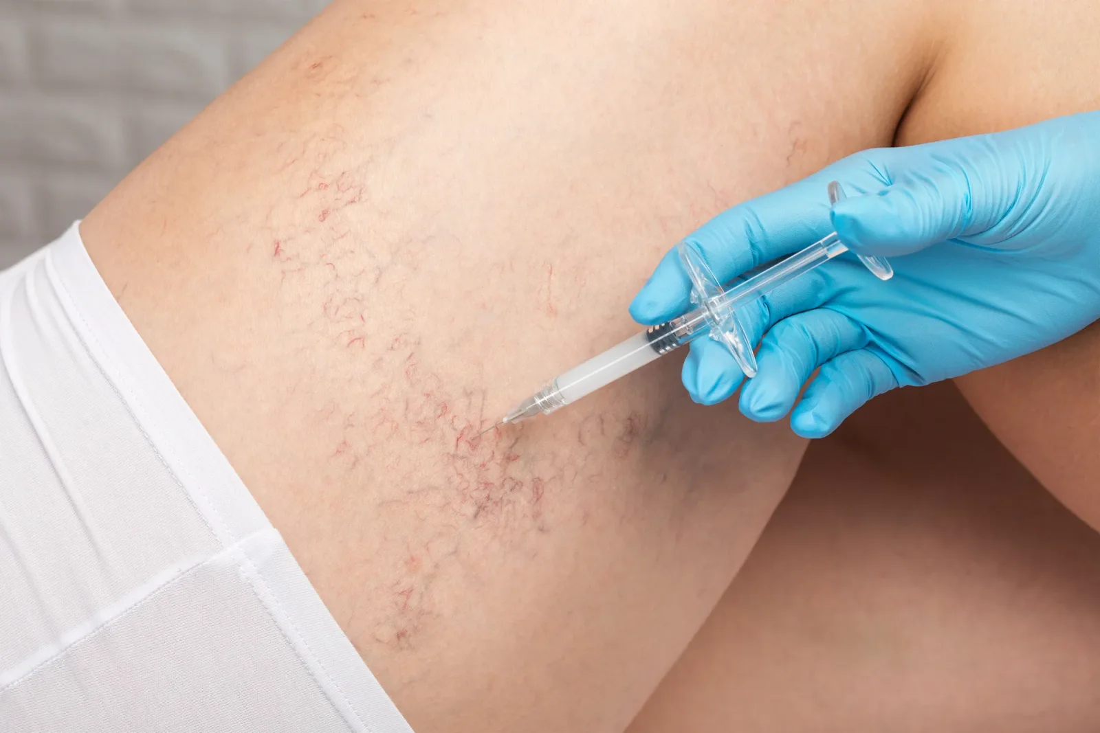 Phlebectomy vs Endovenous Laser Ablation for Chronic Venous