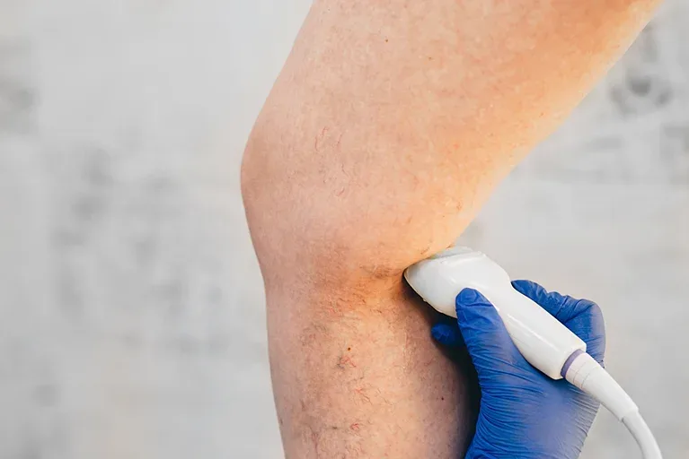 Leg with non ulcerated chronic venous insufficiency receiving treatment.