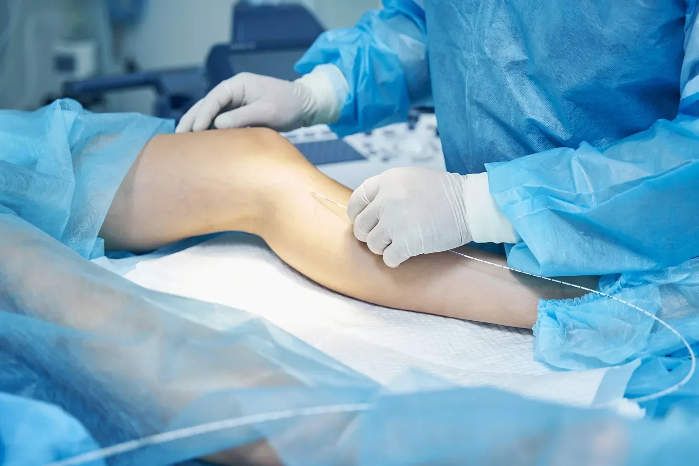 Spider Vein Ablation: A Definitive Guide to Getting Rid of