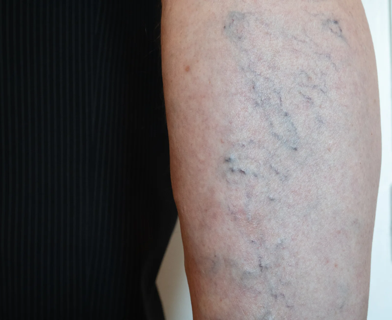 Can Spider Veins Cause Leg Cramps?