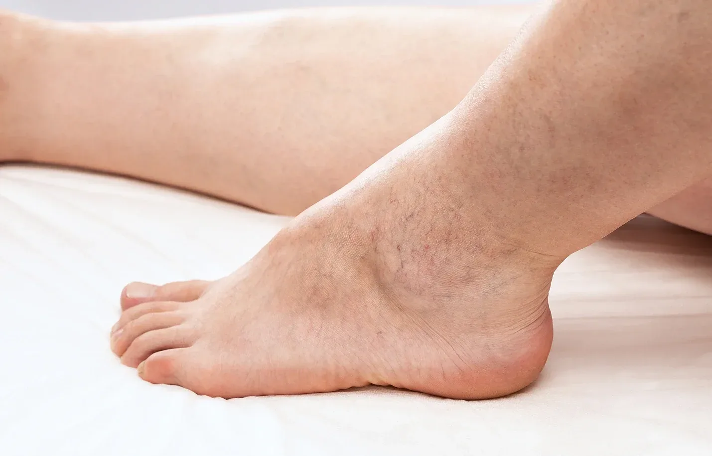 Spider Veins and Stroke: Understanding the Link