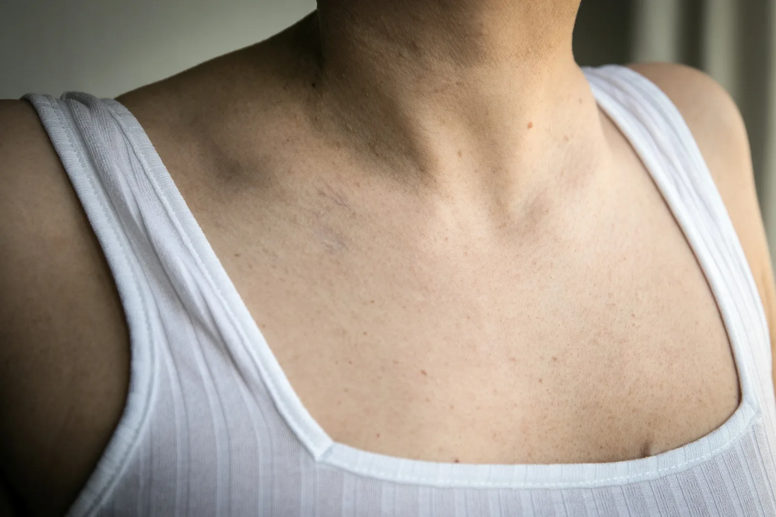 Spider Veins by Breast When Pregnant
