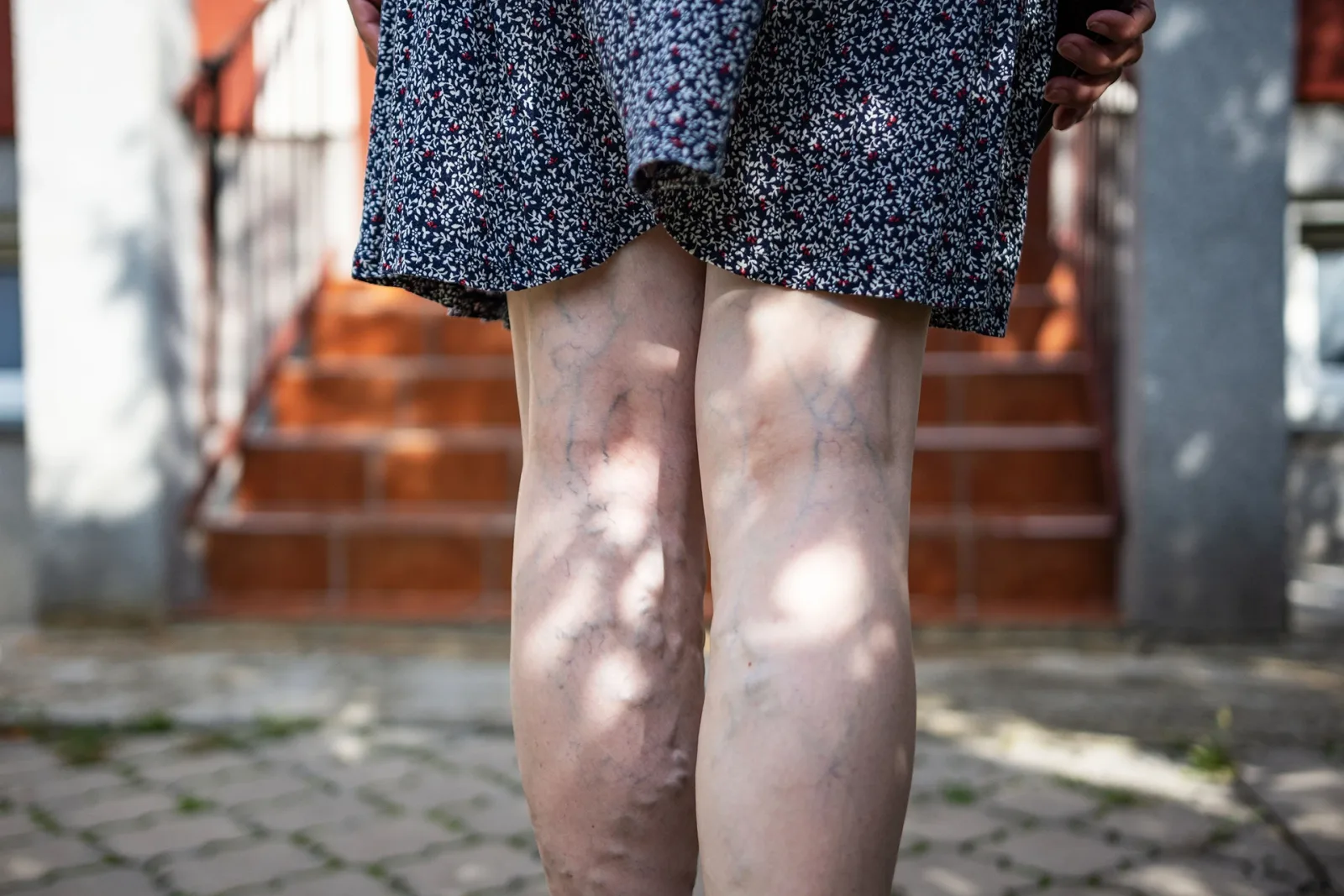 Spider Veins Showing on Legs When Standing