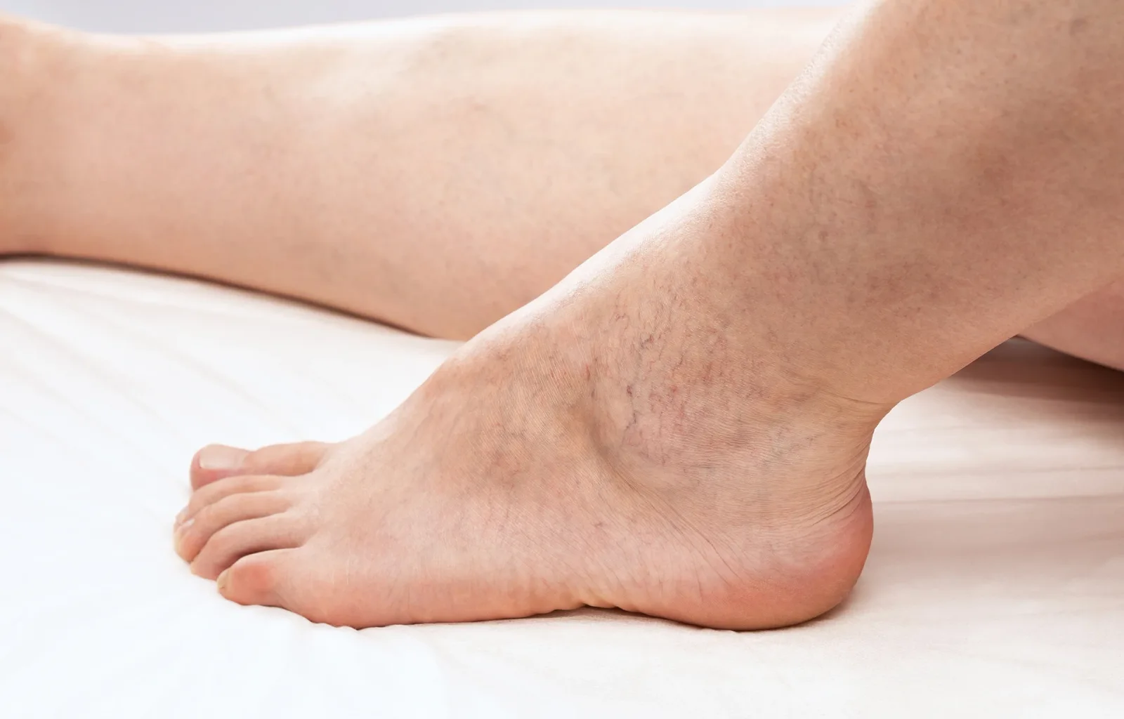 Telangiectasia: Definition, Medical Terminology, and Causes