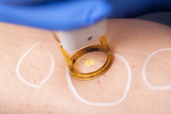 4 Positive Effects of Laser Treatments on Eliminating