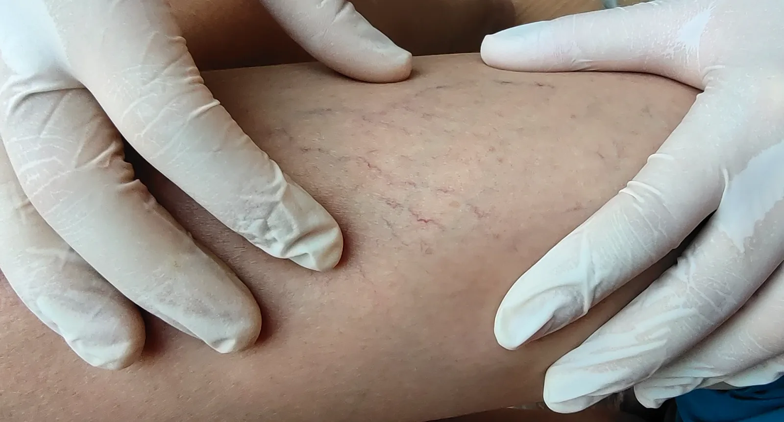 Varicose Veins: When Should They Be Closed?