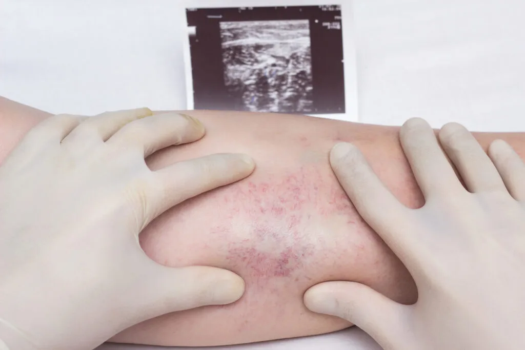 A doctor in gloves examines the veins and legs of the patient