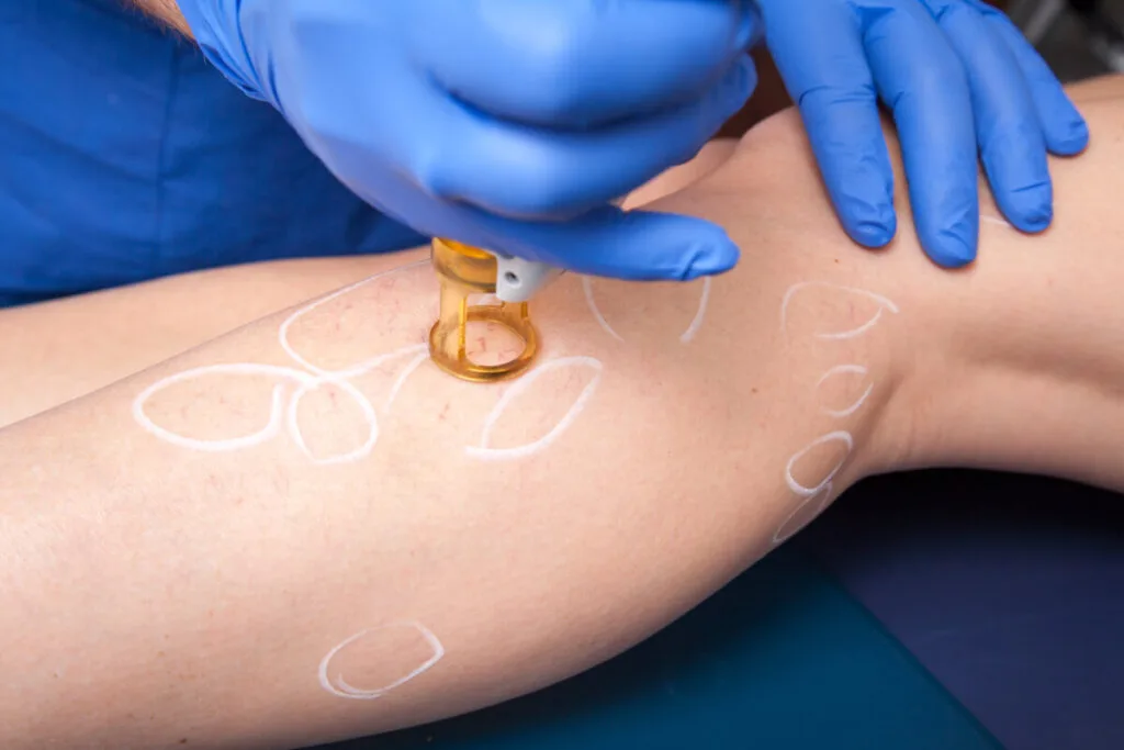laser vein treatment done by professional vein doctor