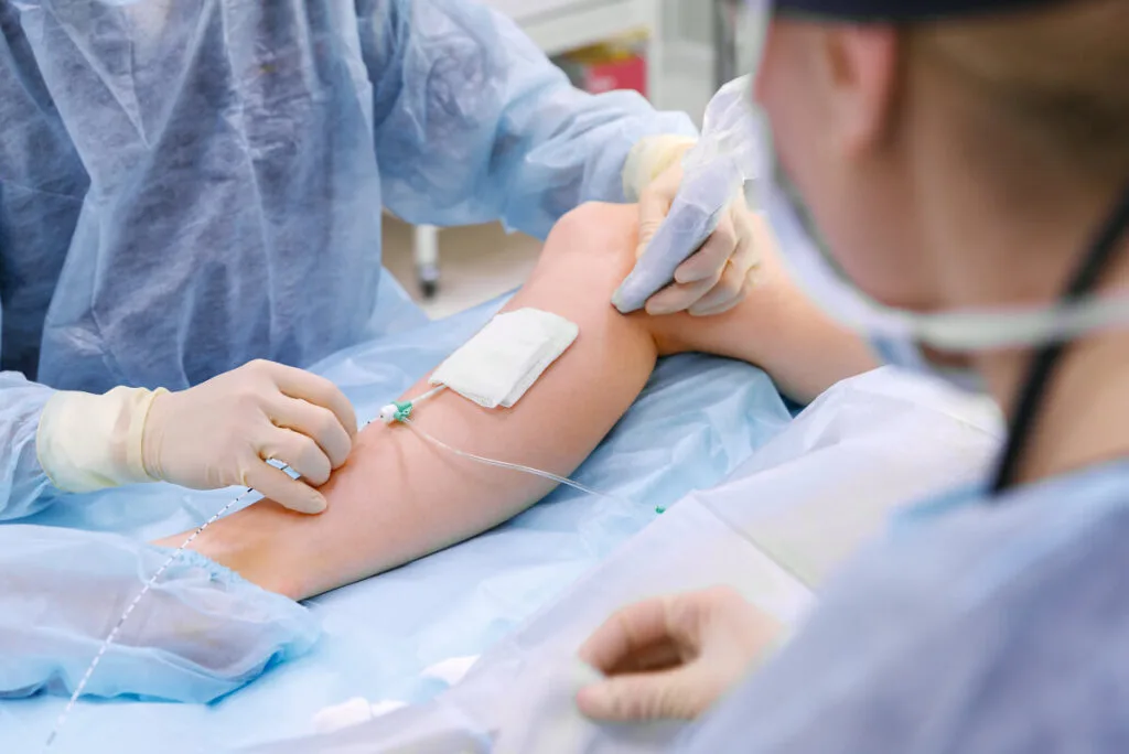 Venaseal Vein treatment performed by professional vein doctors