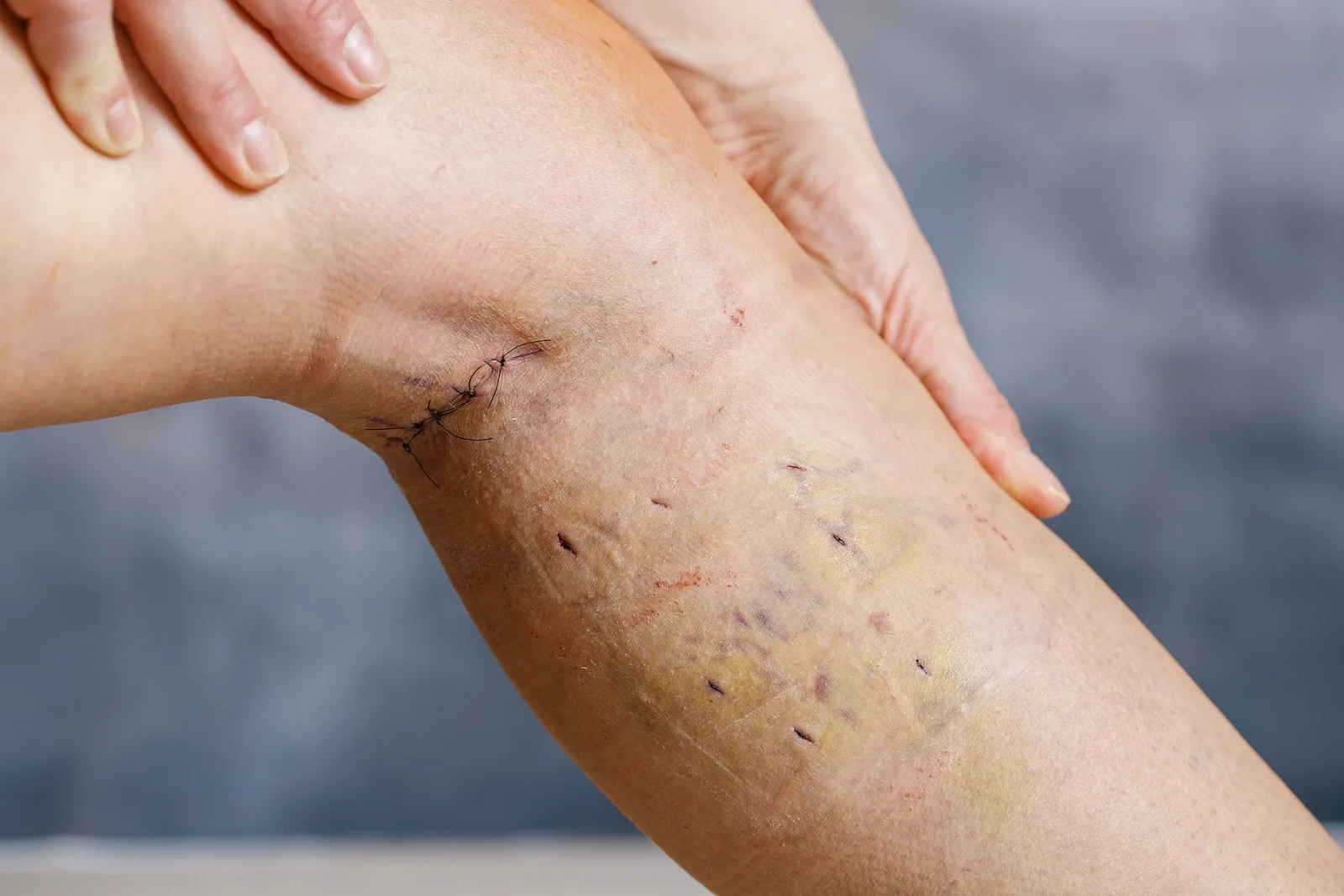 Treating Chronic Venous Insufficiency with Endovenous Laser