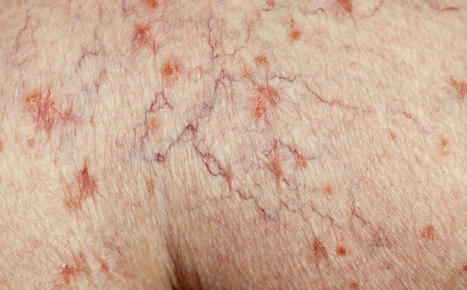 What Happens When a Spider Vein Burst?