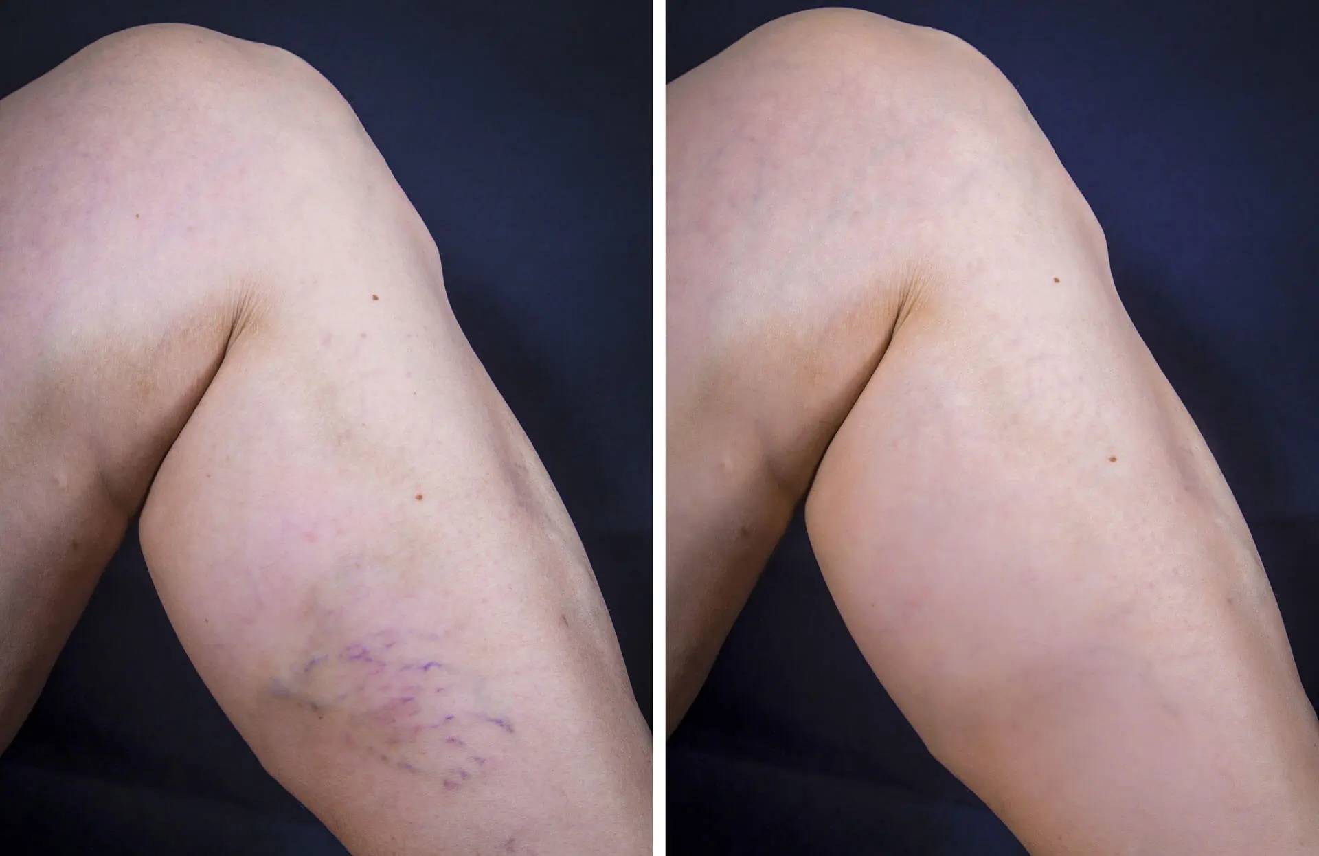 Before and after vein treatment result — spider veins on thigh