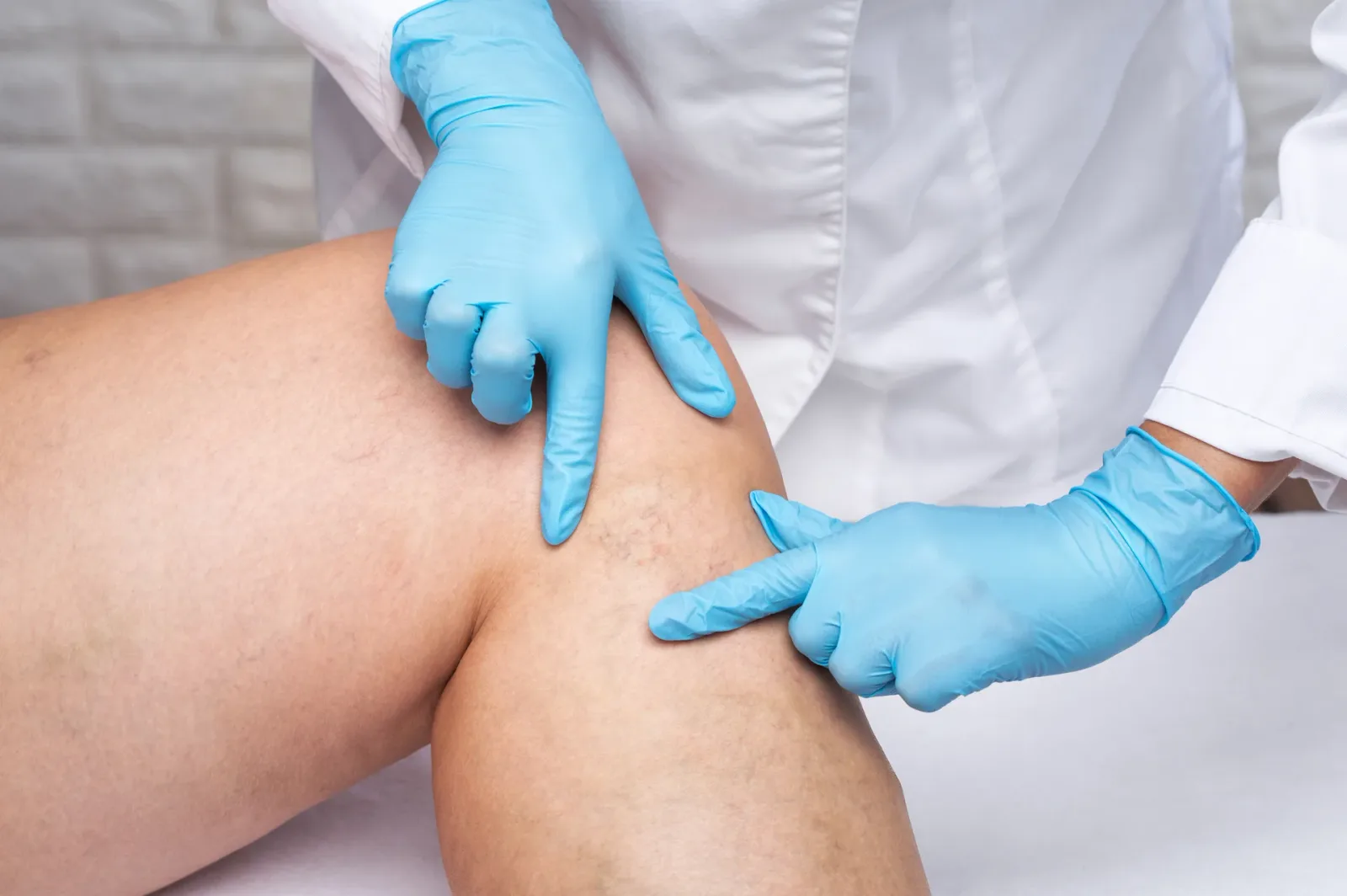 Chronic venous insufficiency evaluation at Vein Center Doctor